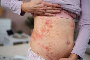 Total de infecções chega a 903 no Estado, que também registra quatro mortes entre moradores não vacinados
